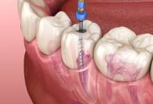 Root Canal