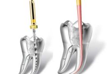Endodontic Rotary Systems